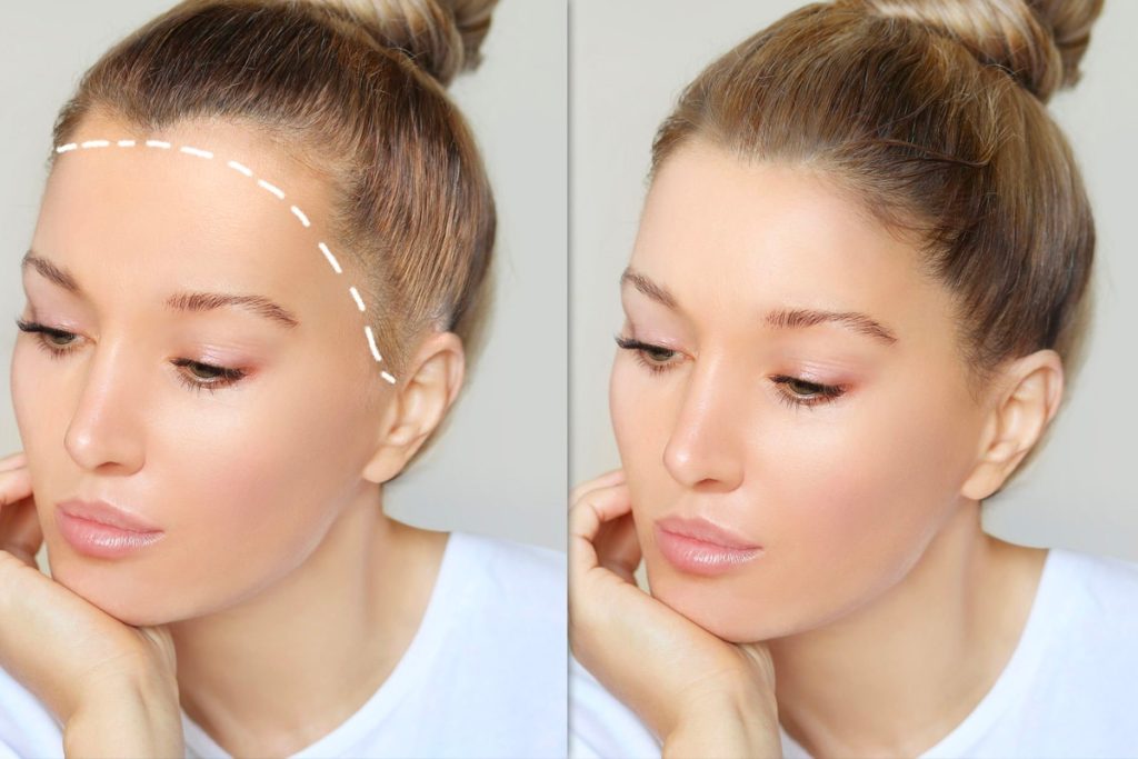 Kadın Saç Ekimi Fiyatları